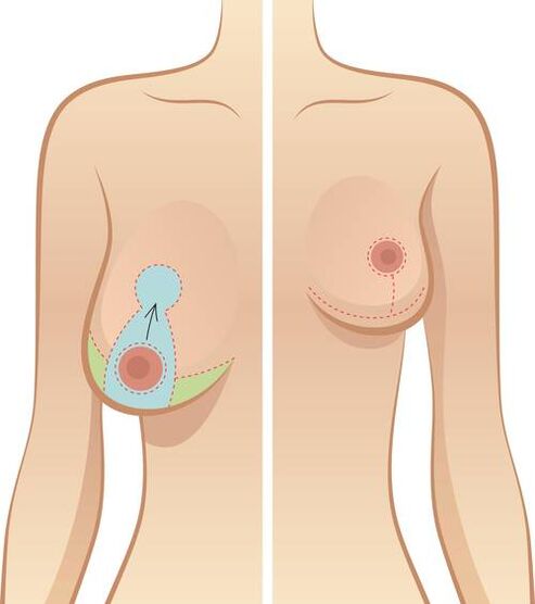 Το Sagging Breasts αποτελεί ένδειξη για τη λειτουργία