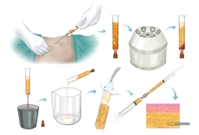 Αφαίρεση λίπους από προβληματικές περιοχές, επεξεργασία και έγχυση στον ιστό του μαστού