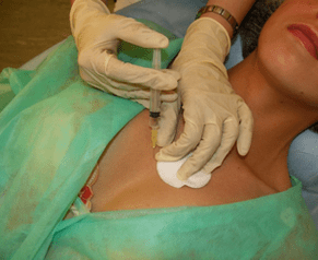 Εισαγωγή meso-cocktail στον ιστό του μαστού - μια εναλλακτική λύση στις ενέσεις υαλουρονικού οξέος