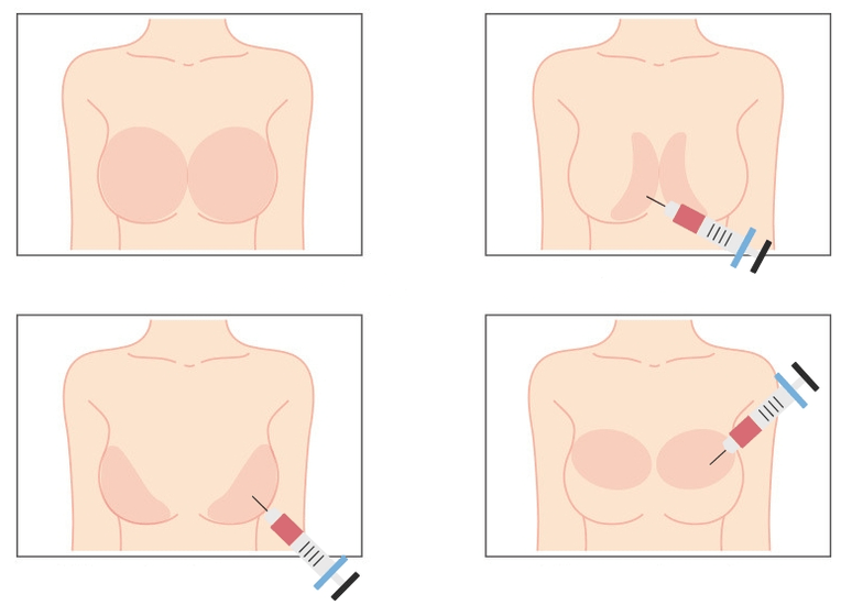 Θέσεις για ένεση υαλουρονικού οξέος στο στήθος