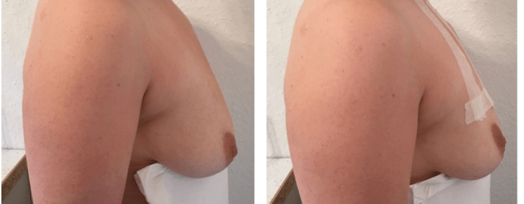 Πριν και μετά την ανόρθωση στήθους με νήματα